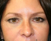 Feel Beautiful - Eyelid Surgery San Diego Case 37 - After Photo